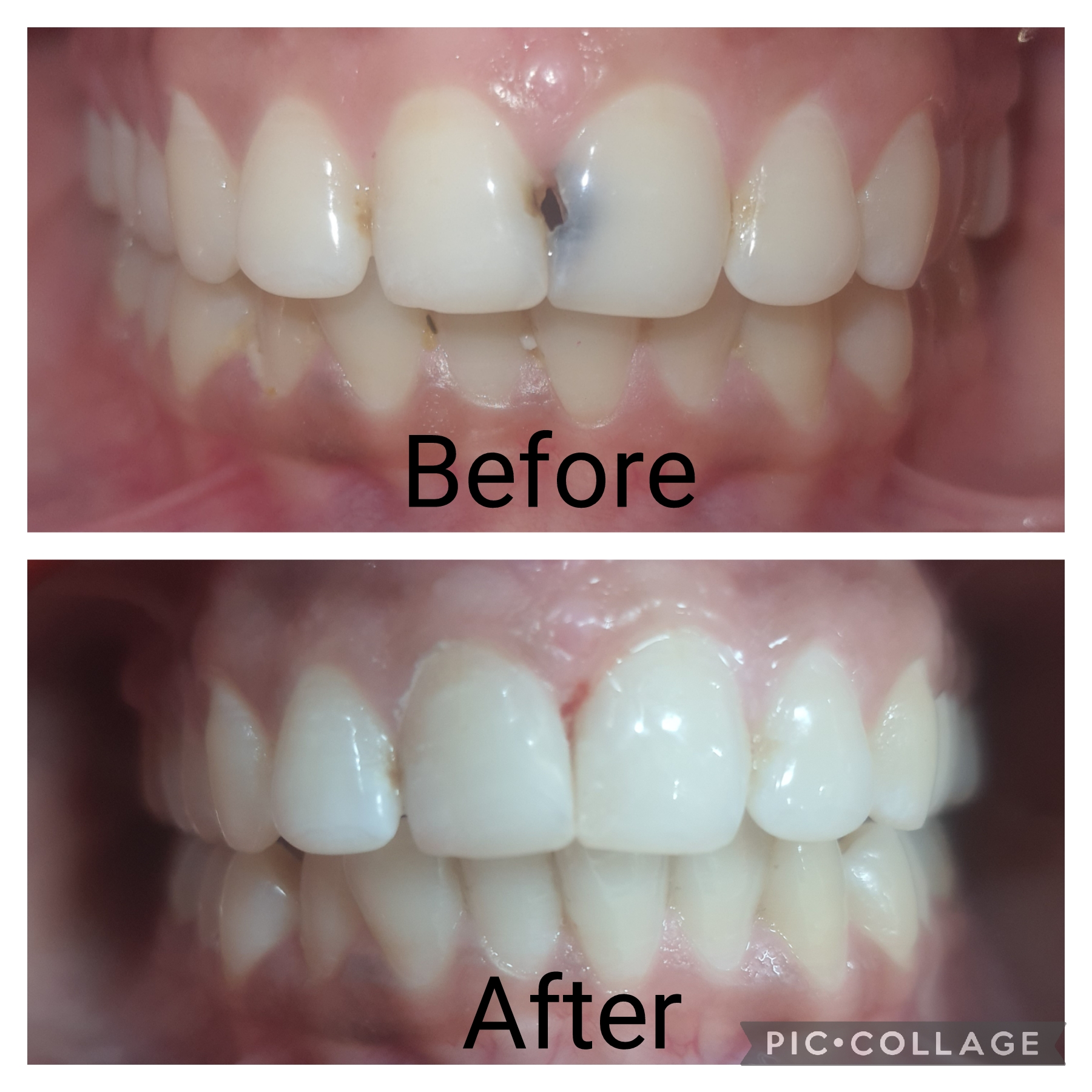 tooth coloured (composite) filling/ restoration